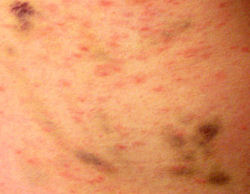 21st Century leprosy & bruising due to scratching